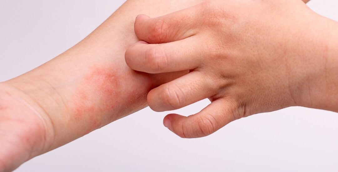 Eczema Causes and Treatment: Find Relief Fast with Urgent Care